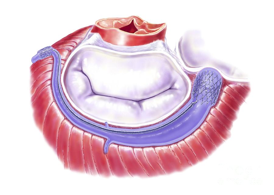 Mitral Valve Annuloplasty, Artwork #3 by Bo Veisland