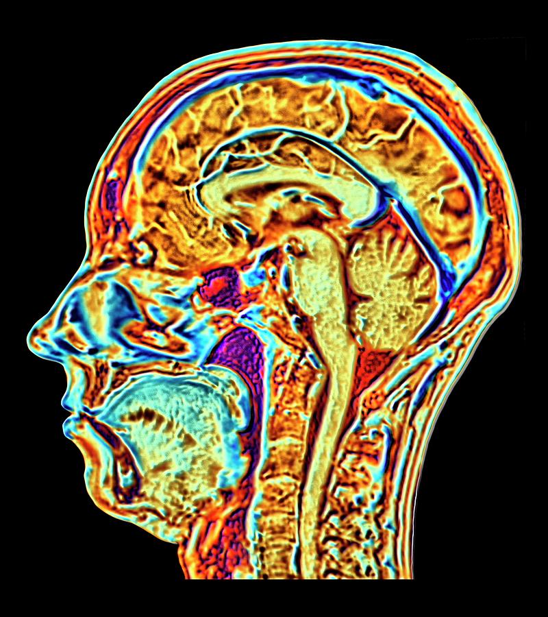 Mri Scan Of Normal Brain Photograph By Alfred Pasieka Science Photo Library My XXX Hot Girl