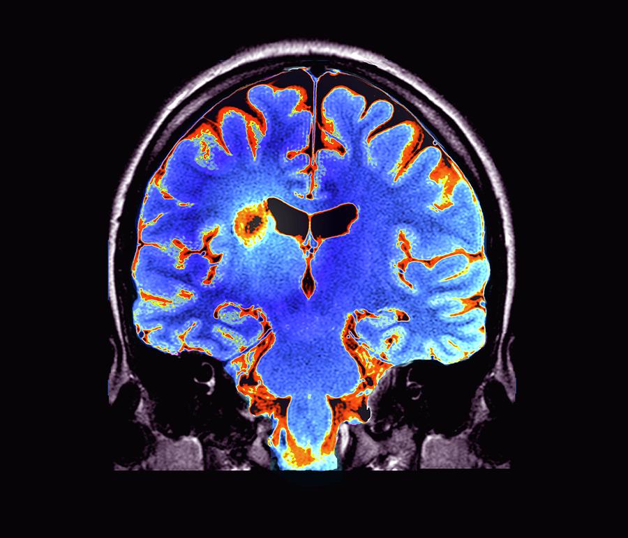 Multiple Sclerosis #3 Photograph by Zephyr/science Photo Library