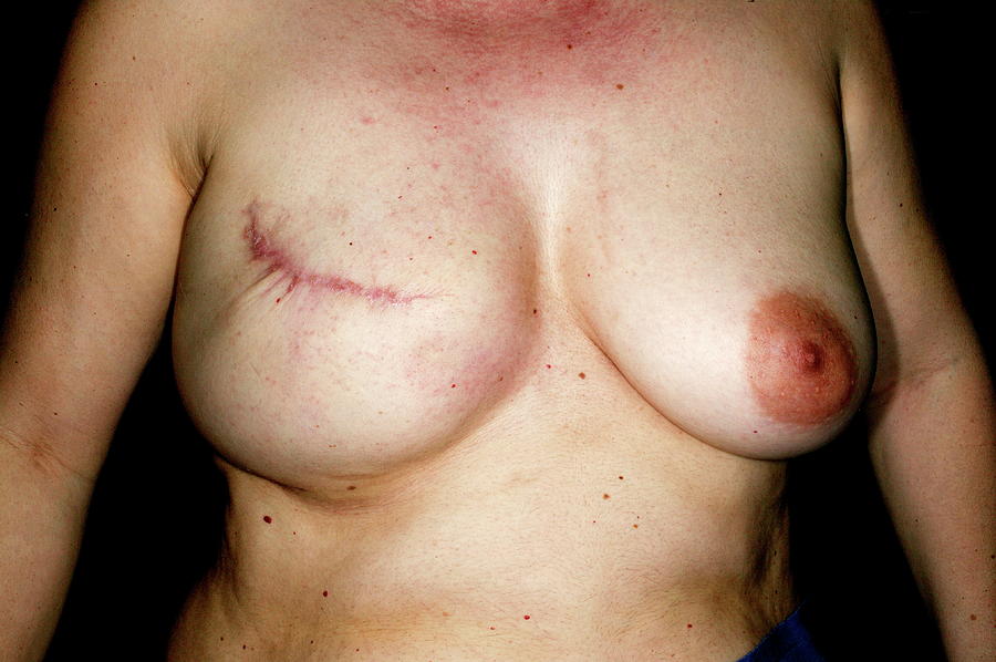 Nude Photograph - Nipple Reconstruction Surgery #3 by Mauro Fermariello/science Photo Library
