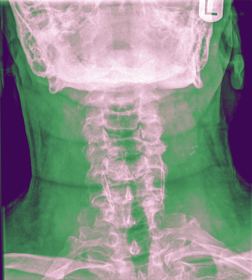 Normal Cervical Spine X-ray #3 by Photostock-israel