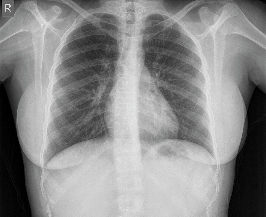 normal chest x ray findings report