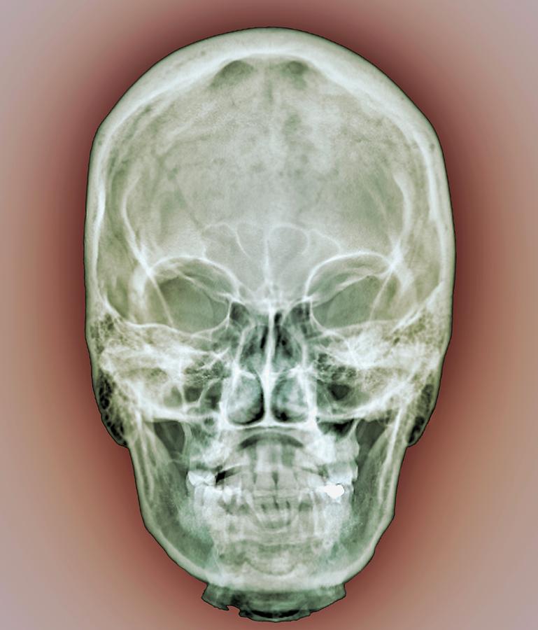 Normal Skull Photograph by Zephyr/science Photo Library - Fine Art America