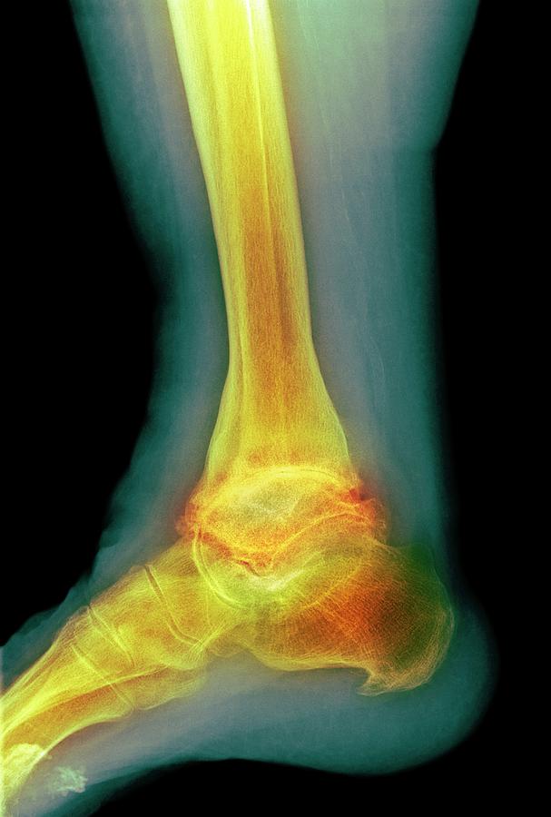 Osteoarthritis Of The Ankle Photograph By Science Photo Library Fine Art America 3924