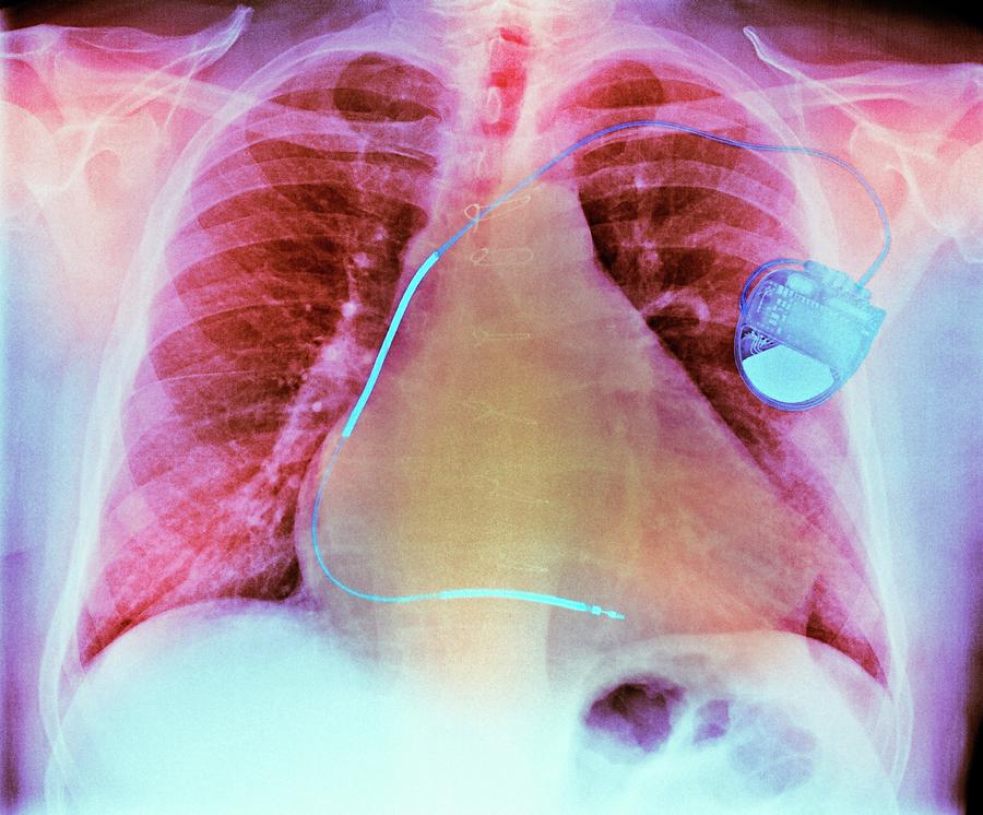 Pacemaker In Heart Disease Photograph by Dr P. Marazzi