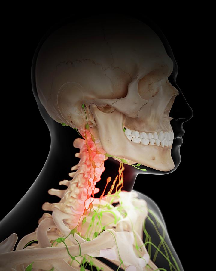 Painful Human Lymph Nodes #3 Photograph by Sebastian Kaulitzki/science ...