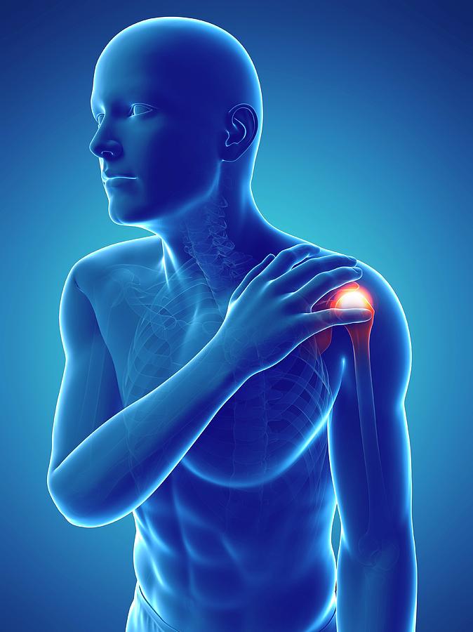 Painful Shoulder Photograph by Sciepro/science Photo Library | Pixels