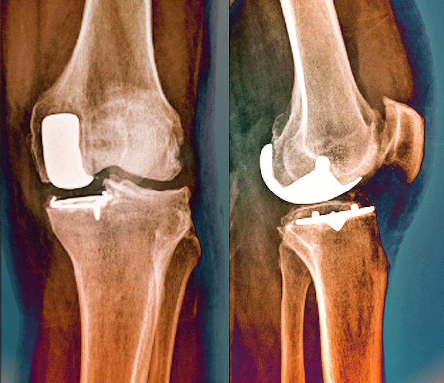 Can You Damage A Partial Knee Replacement