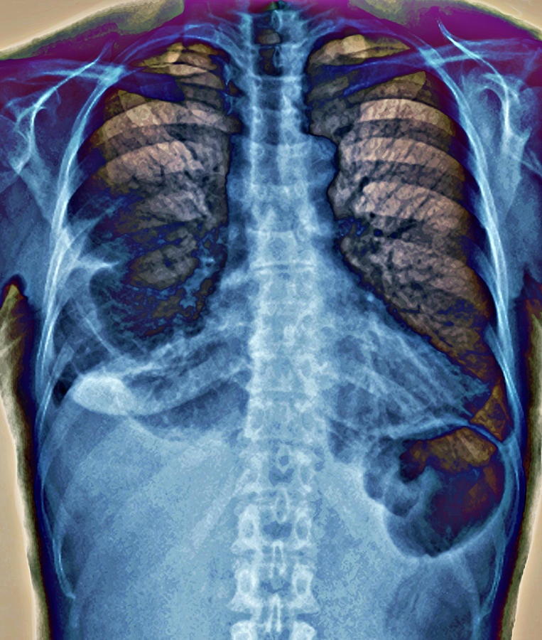 Pleurisy #3 Photograph by Zephyr/science Photo Library