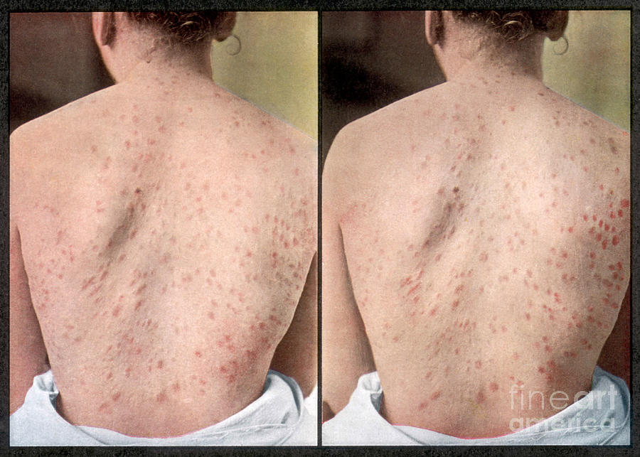 Rash Caused By Syphilis, Vintage #3 Photograph by DoubleVision