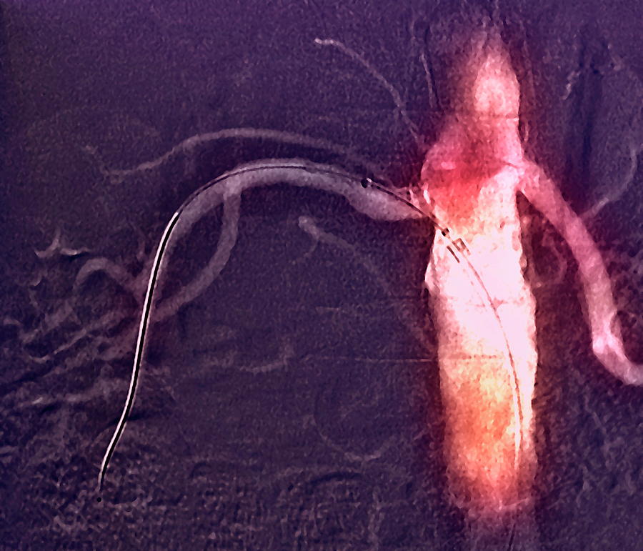 Renal Angioplasty #3 Photograph by Zephyr/science Photo Library