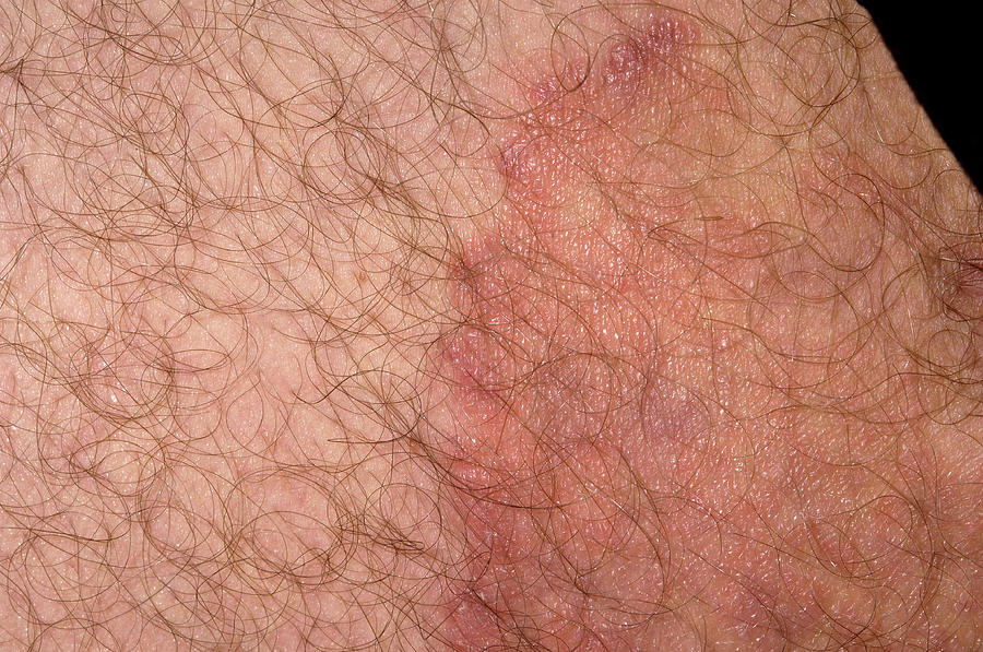 Ringworm Fungal Infection Photograph By Dr P Marazziscience Photo Library