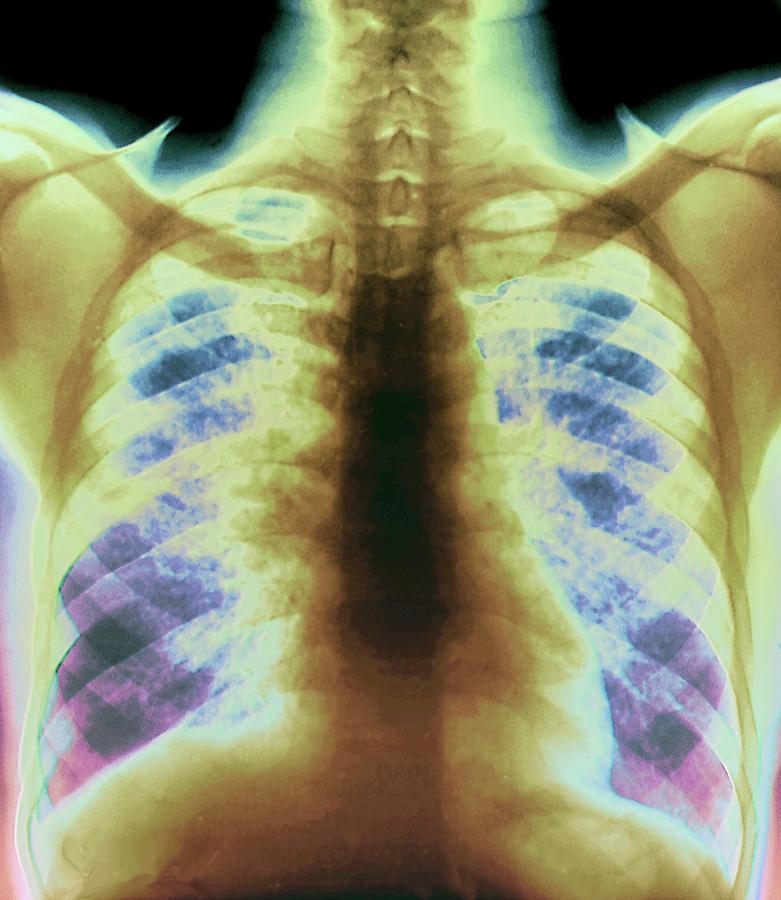 Sarcoidosis Of The Lungs Photograph by Zephyr/science Photo Library ...