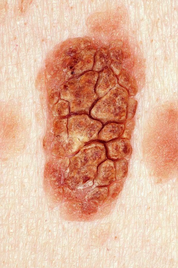 Seborrhoeic Wart On The Skin Photograph by Dr P. Marazzi/science Photo ...