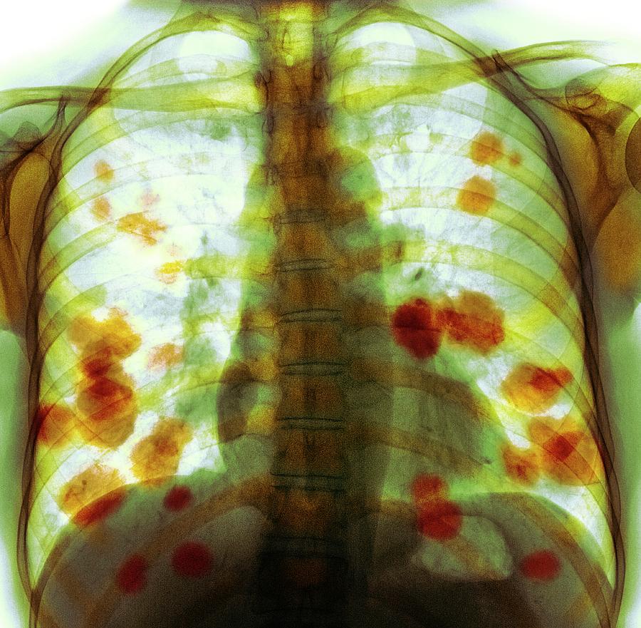 Secondary Lung Cancer Photograph by Science Photo Library - Pixels