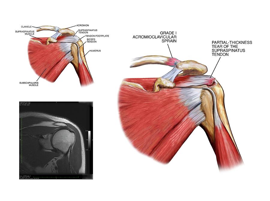 shoulder tendon injury