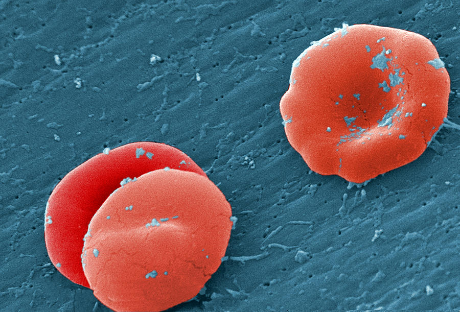 Sickle Cell Anemia, Human Rbcs, Sem #3 Photograph by Science Source