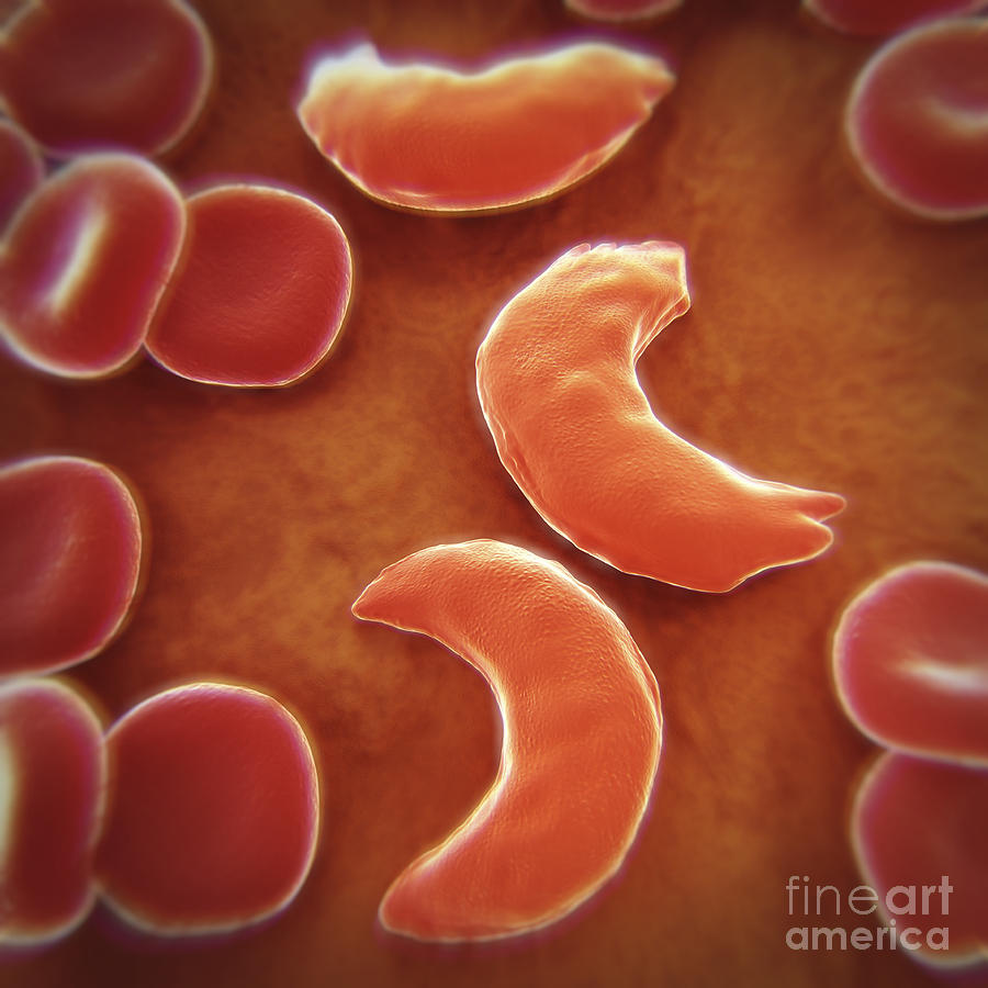 Sickle-cell Disease #3 Photograph by Science Picture Co