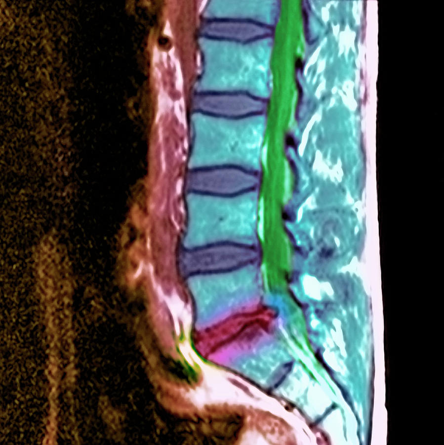 Slipped Disc #3 Photograph by Simon Fraser/science Photo Library