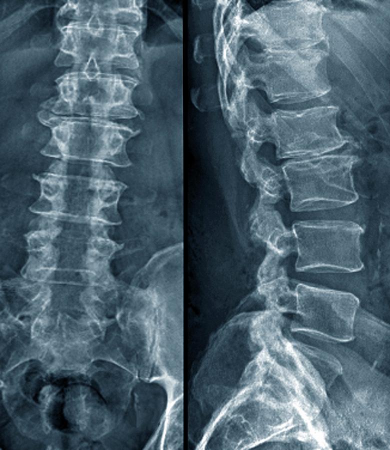 Spinal Stenosis After Surgery #3 by Zephyr