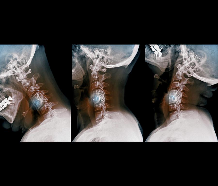 Fifties Photograph - Spine Fixation #3 by Zephyr/science Photo Library
