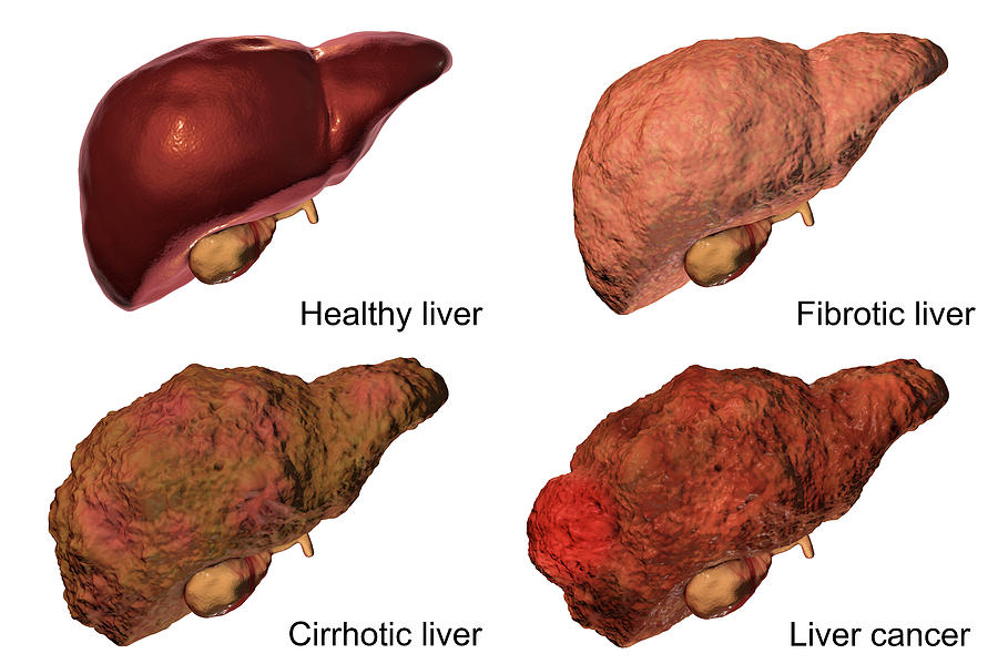 three stages of diseases