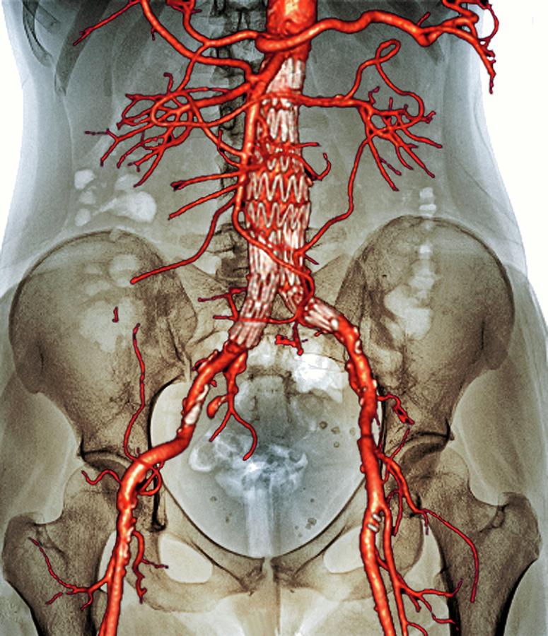 Stent In Aortic Aneurysm Photograph By Zephyrscience Photo Library Pixels 5379