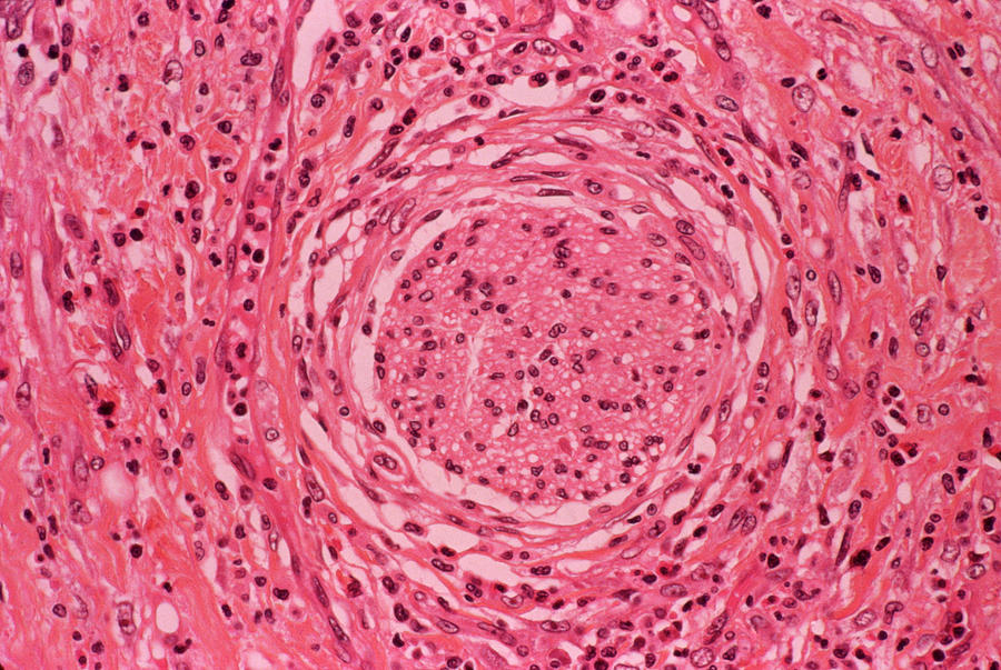 Stomach Photograph - Stomach Ulcer #3 by Cnri/science Photo Library