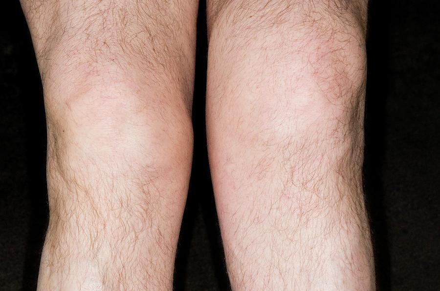 Swollen Knee Photograph By Dr P Marazziscience Photo Library 0839