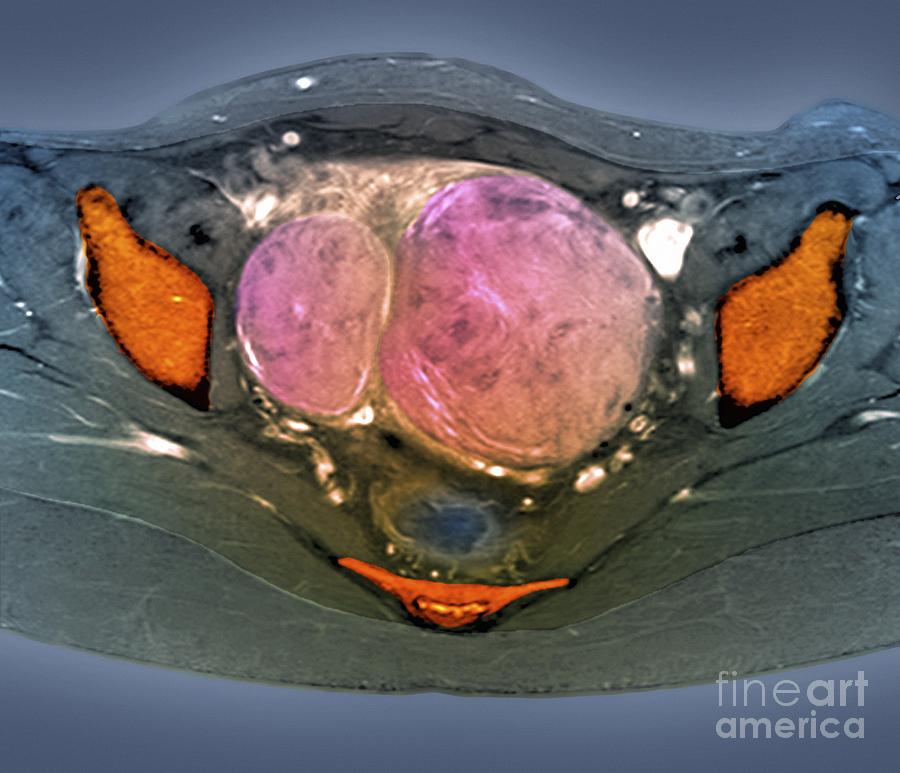 Uterine Fibroids, Mri Scan Photograph by Zephyr - Pixels