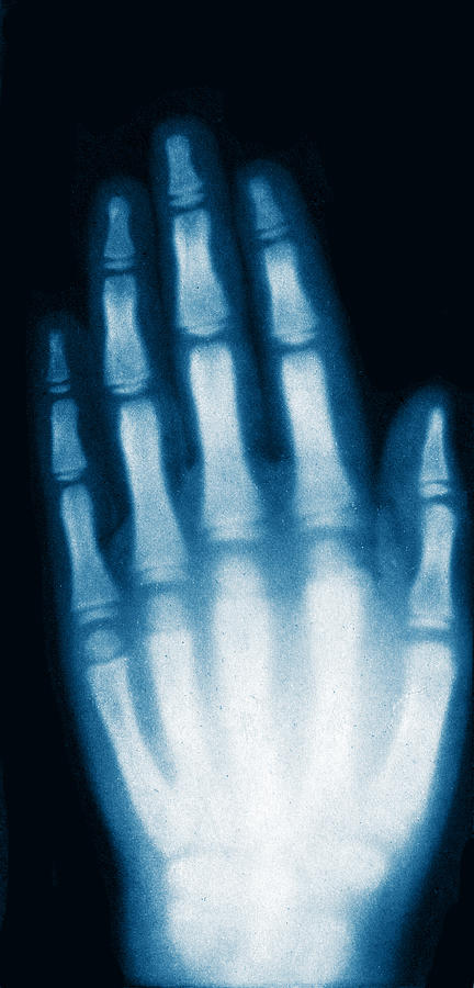 X-ray Of Girls Hand, 1896 #3 Photograph by Science Source