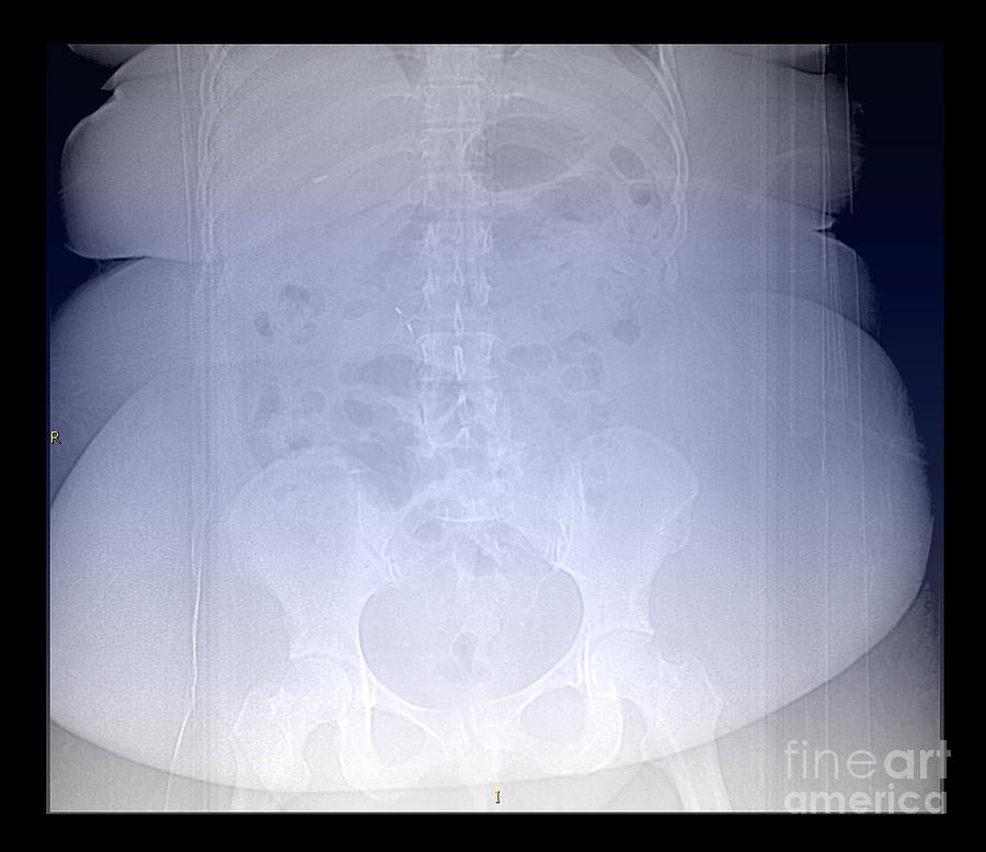 X-ray Of Morbidly Obese Patient #3 Photograph by Living Art Enterprises