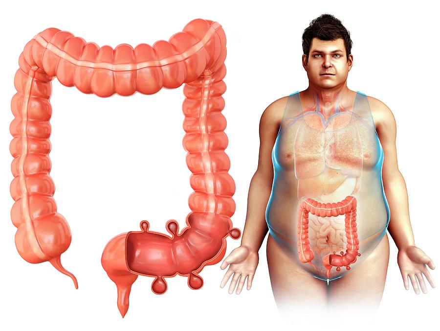 Illustration Photograph - Diverticulosis #30 by Pixologicstudio/science Photo Library