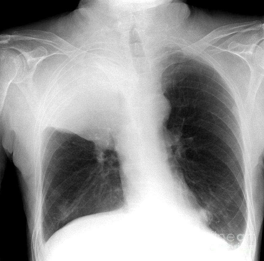 Lung Cancer Xray Ledpikol