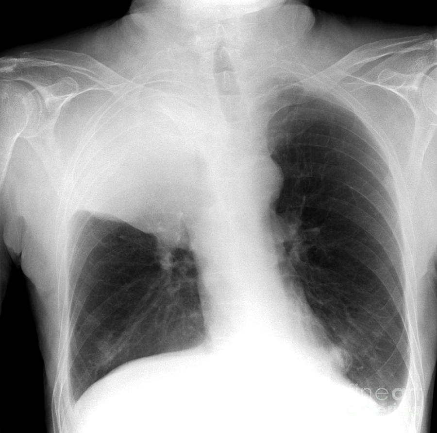 Lung Cancer Xray Ledpikol 4879