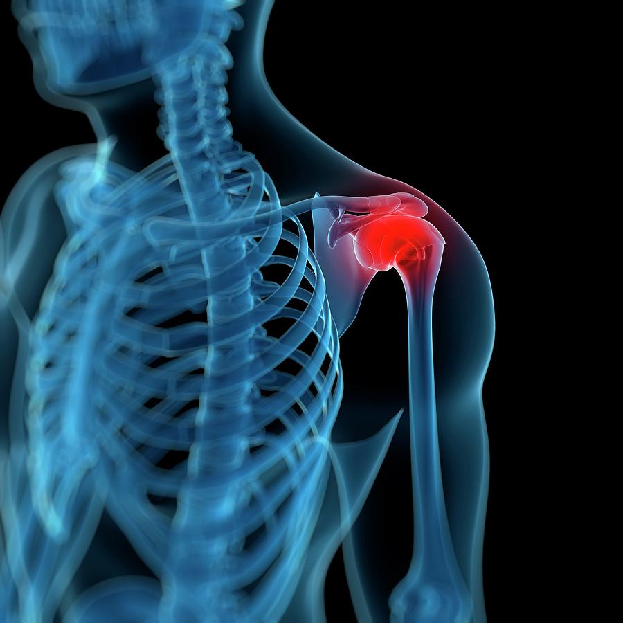 Shoulder Pain #33 Photograph by Sciepro/science Photo Library - Fine ...