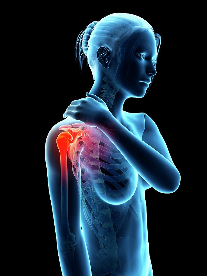 Skeleton Photograph - Human Shoulder Pain #34 by Sebastian Kaulitzki