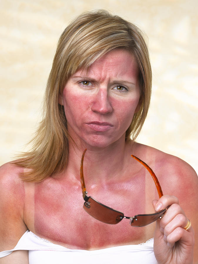 35 Year Old Woman With Sunburn Photograph by Peter Dazeley
