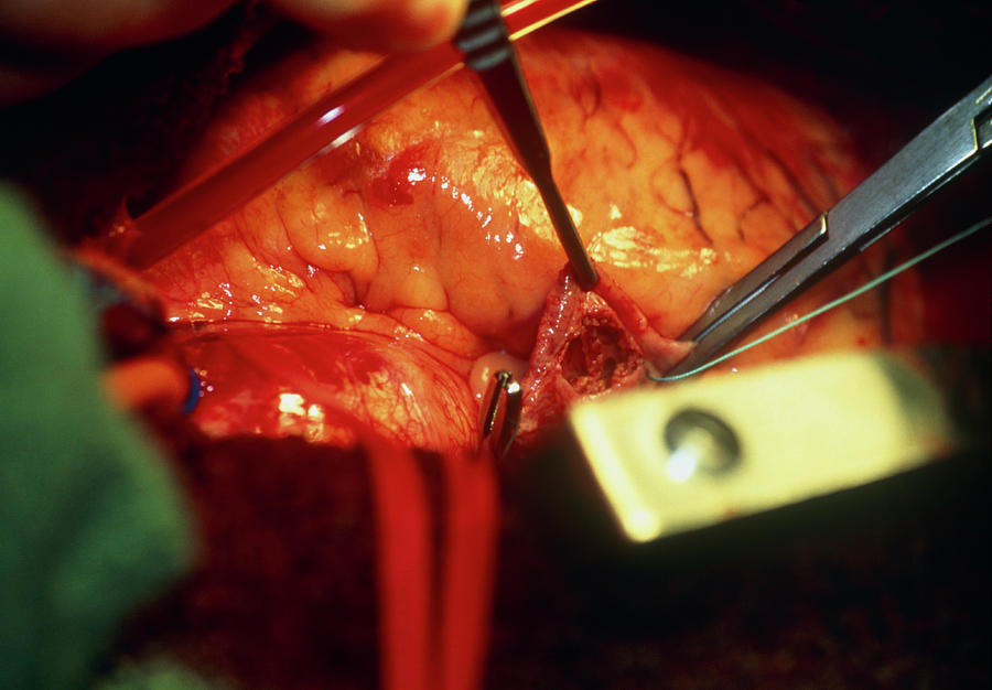 Scissor Photograph - Heart Surgery #37 by Antonia Reeve/science Photo Library