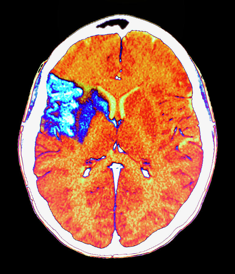 Stroke #37 Photograph by Zephyr/science Photo Library