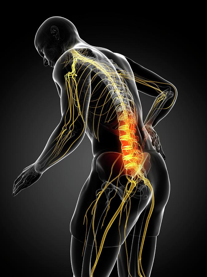 Back Pain Photograph by Sciepro/science Photo Library | Fine Art America