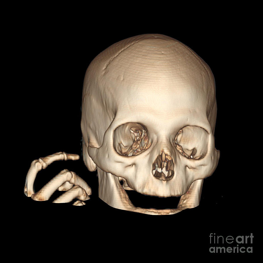 3d Ct Reconstruction Of Head And Hand Photograph by Living Art Enterprises