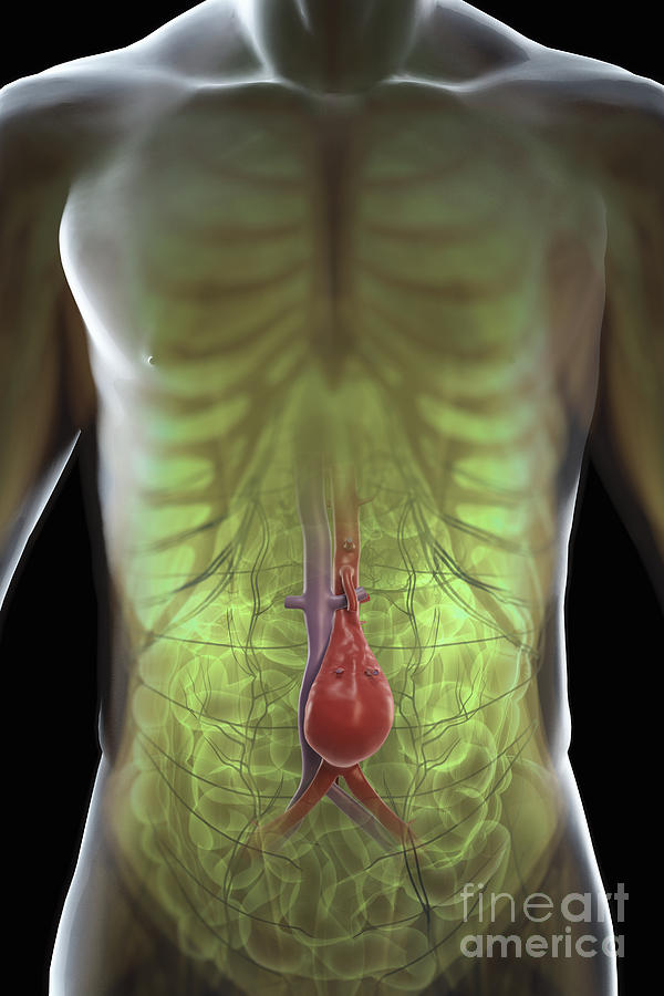 Abdominal Aortic Aneurysm #4 Photograph by Science Picture Co