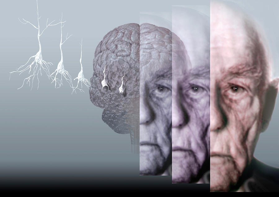 Alzheimers Disease Photograph by Hans-ulrich Osterwalder