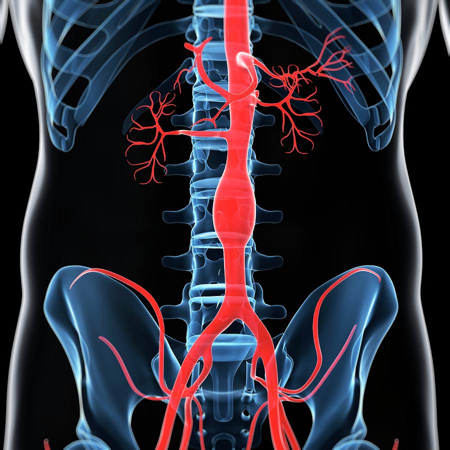 Aortic Aneurysm Photograph By Scieproscience Photo Library Pixels