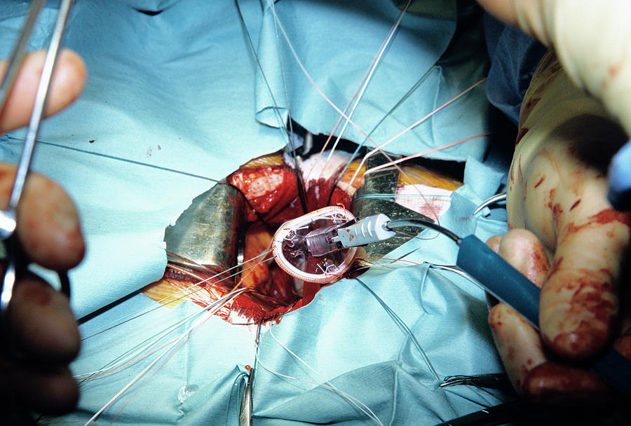 Ring Photograph - Artificial Heart Valve Surgery #4 by Antonia Reeve/science Photo Library