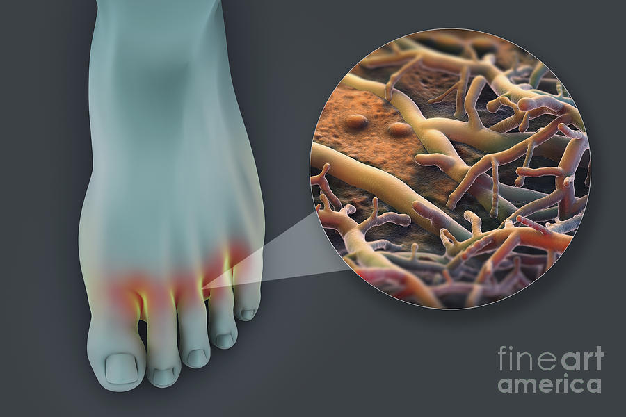 Athletes Foot #4 Photograph by Science Picture Co