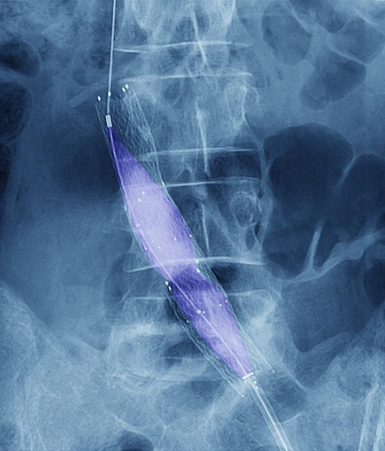 Balloon angioplasty, X-ray #4 Photograph by Science Photo Library