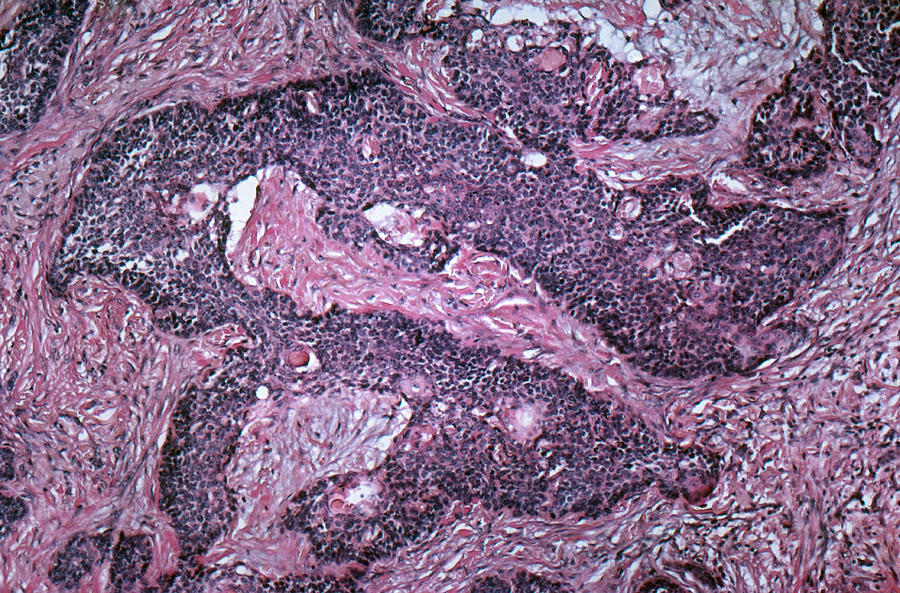 Basal-cell Carcinoma, Lm #4 Photograph by Michael Abbey