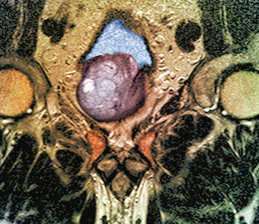 Benign Prostatic Hyperplasia Photograph By Zephyr